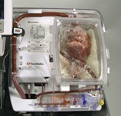 australian-doctors-transplant-dead-hearts-in-surgical-breakthrough-healthinnovations