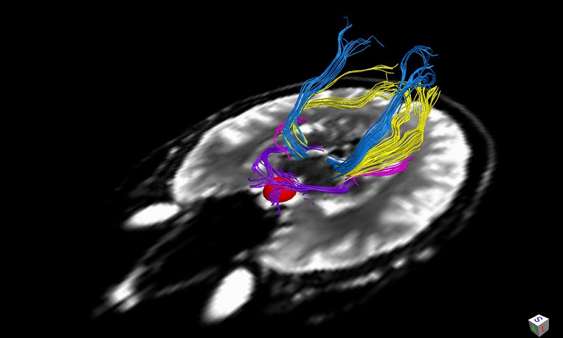 Shown is a representation of the human visual pathway, including the optic chiasm and tracts (purple) and radiations (blue, yellow, and pink) revealed by magnetic resonance imaging. The subject had a large pituitary tumor (red) that caused compression and demyelination of the optic chiasm resulting in vision loss. Surgical removal of the tumor resulted in rapid remyelination and vision recovery in this patient and others (Paul et al.). Elucidation of the principles that govern such rapid remyelination should have therapeutic implications for other kinds of central nervous system injury.  [CREDIT: D. A. PAUL/UNIVERSITY OF ROCHESTER SCHOOL OF MEDICINE] 