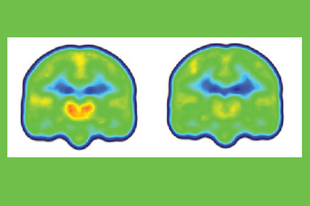 Images created by averaging PET scan data from chronic pain patients (left) and healthy controls (right) reveals higher levels of inflammation-associated translocator protein (orange/red) in the thalamus and other brain regions of chronic pain patients.  Credit: Marco Loggia/Martinos Center for Biomedical Imaging, MGH. 