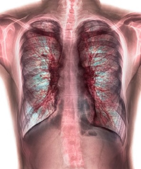 Coloured chest X-ray (front view) showing mucus in the lungs in a 28 year old male patient with cystic fibrosis (CF). The patient suffers from shortness of breath (dyspnea). CF is a hereditary disease affecting the lungs in which abnormal production of mucus can lead to severe respiratory infection.  Credit: PHOTOSTOCK-ISRAEL/SCIENCE PHOTO LIBRARY.
