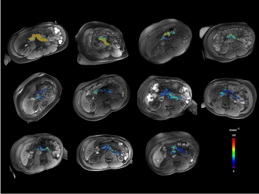 3D reconstructions of pancreata of 11 patients with T1D. A pseudocolor = ΔR2* map was fused onto a volume-rendered 3D-T1 VIBE MRI image dataset. Shown are the 11 patients with recent-onset T1D.  Noninvasive mapping of pancreatic inflammation in recent-onset type-1 diabetes patients.  Gaglia et al 2015.