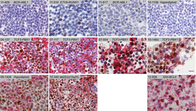 Pre-BCR Signaling in ALL Cells Drives Expression of BCL6.   Immunohistochemistry double-stainings for BCL6 (nuclear, brown) and mHC (cytoplasmic/membrane, red) on the same slides of paraffin-embedded bone marrow samples from pre-BCR and pre-BCR + ALL patients. A Burkitt’s lymphoma sample (12–926) carrying an IGH-BCL6 gene rearrangement was used as a positive control. Scale bars represent 20mm.  Self-Enforcing Feedback Activation between BCL6 and Pre-B Cell Receptor Signaling Defines a Distinct Subtype of Acute Lymphoblastic Leukemia.  Geng et al 2015.