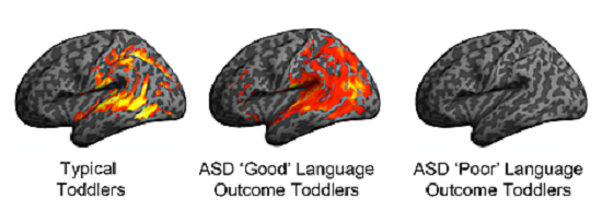 Image depicts patterns of brain activation in typically developing, ASD “Good” and ASD “Poor” language ability toddlers in response to speech sounds during their earliest brain scan (ages 12-29 months). The imaging occurred one to two years prior to their language outcome designation at age 30-48 months. Note similarity in patterns of activation between the ASD Good and typically developing toddlers, which display robust activation in classic language brain regions, such as the superior temporal gyrus. In contrast, the ASD Poor language toddlers showed no statistically significant activation in classic language regions.  Credit:   UC San Diego Autism Center.