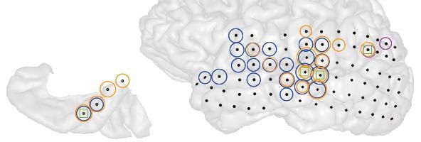 This is a 3-D image of the left brain hemisphere of a patient with tinnitus (right) and the part of that hemisphere containing primary auditory cortex (left). Black dots indicate all the sites recorded from. Colored circles indicate electrodes at which the strength of ongoing brain activity correlated with the current strength of tinnitus perceived by the patient. Different colors indicate different frequencies of brain activity (blue = low, magenta = middle, orange = high) whose strength changed alongside tinnitus. Green squares indicate sites where the interaction between these different frequencies changed alongside changes in tinnitus.  Credit:  Sedley, W et al. 