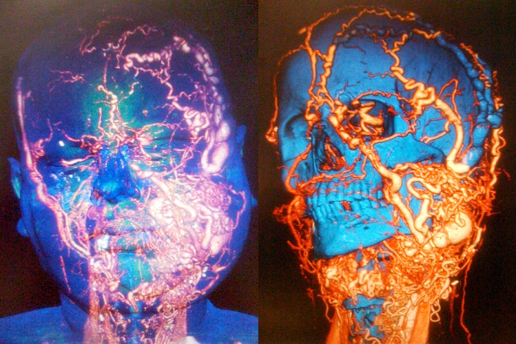 A man, who did not want to be identified, underwent the 'world's most complex' face transplant to reconstruct his neck, mouth, tongue and throat. The X-ray on the right-hand side shows him before the operation.  The X-ray on the left-hand side shows the man after having his entire lower face reconstructed, which doctors say allowed him to live a 'normal life'.  Credit:  Vall d'Hebron University Hospital 2015. 