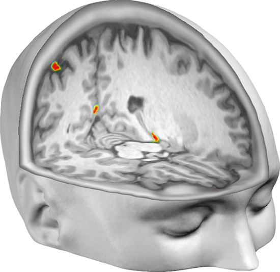 Brain regions in which the scientists could successfully decode the participants’ perceived self-location from patterns of neural activity. Credit: Malin Björnsdotter/Arvid Guterstam.  Henrik Ehrsson , Arvid Guterstam , Malin Björnsdotter.