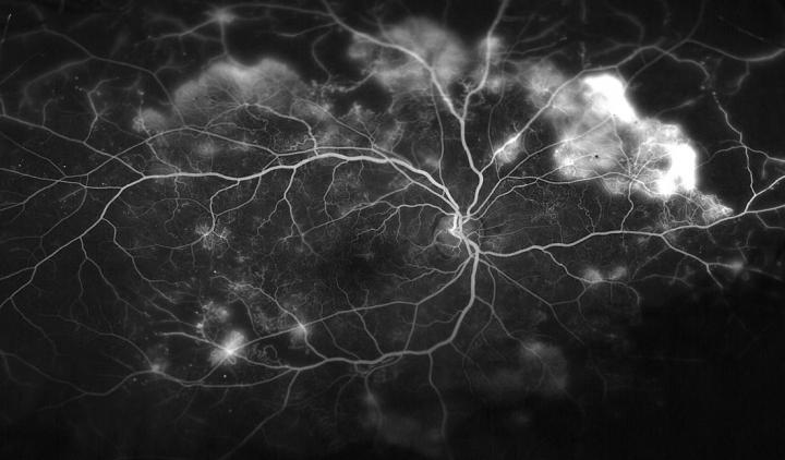 This image shows the blood vessels in the retina of a patient with proliferative diabetic retinopathy.  Credit:  Wilmer Photography. 