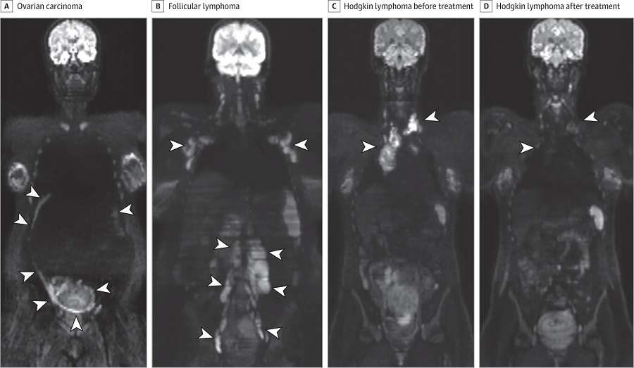Whole-Body Diffusion-Weighted Magnetic Resonance Images.  A, Ovarian carcinoma in patient 1. B, Follicular lymphoma in patient 2. C and D, Hodgkin lymphoma before (C) and after (D) treatment in patient 3. The arrowheads in all panels point to the tumor locations. D, Arrowheads point to areas of treatment response (complete remission).  Presymptomatic Identification of Cancers in Pregnant Women During Noninvasive Prenatal Testing.  Vermeesch et al 2015.