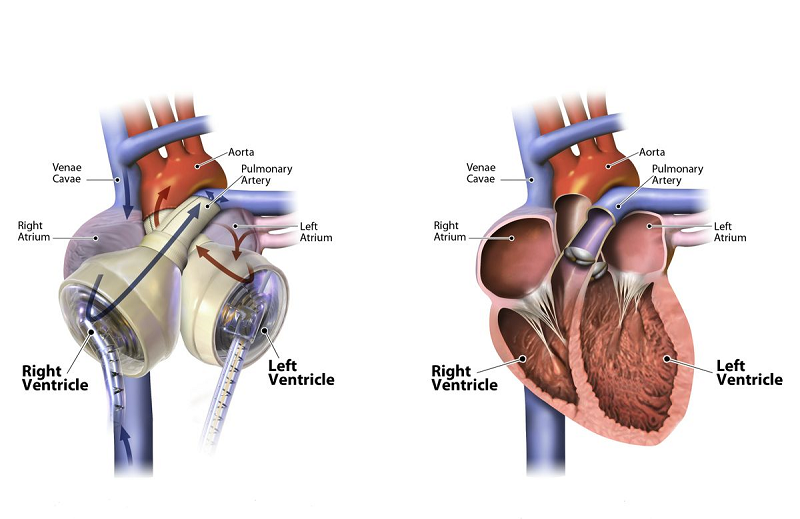 The SynCardia Total Artificial Heart, at left, and a human heart, at right.  Credit: SynCardia 2015