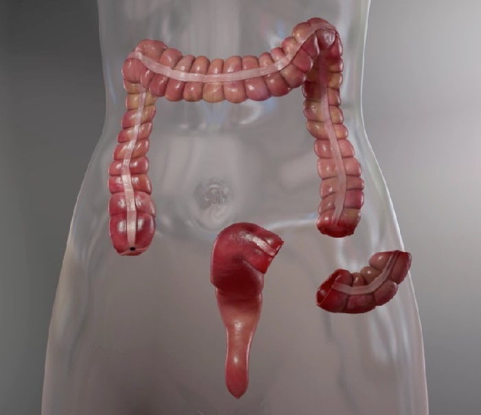 Liquid biopsy identifies mutations in colorectal cancer undetected in tissue biopsy - healthinnovations