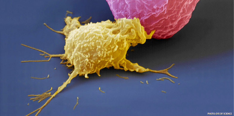 Natural killer cells (yellow) identifies and kills cancer cells (pink) or virus infected cells before they wreak havoc on the organism.   (Photo: eye of science).