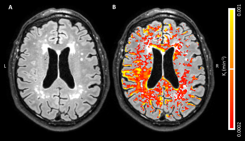  A, Axial fluid-attenuated inversion recovery image in a 68-year-old man with, B, corresponding blood-brain barrier leakage rate (Ki) maps superimposed. Leakage rate values appear diffusely distributed on both images, with some periventricular hot spots. Leakage manifests in normal-appearing white matter, white matter hyperintensities and gray matter. Voxels with low signal-to-noise ratio in MRI signal intensity were removed, and leakage rate map was masked to cerebrum.  Credit: Maastricht University Medical Center in Maastrich.