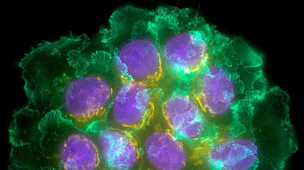 Scientists block breast cancer cells from hiding in bones - healthinnovations