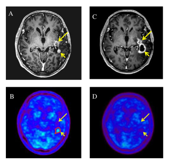 Recurrent glioblastoma multiforme (GBM) in a 55-year-old man before and after hypofractionated stereotactic radiotherapy by intensity modulated radiation therapy (HS-IMRT). Before HS-IMRT, two enhanced lesions (long and short arrow) were demonstrated in the left temporal lobe on T1-weighted magnetic resonance imaging (A). 11C-methionine positron emission tomography (MET-PET) demonstrated a MET high-uptake on the region of short arrow, which was defined as the Gross Tumor Volume (red line) (B). 5 months after HS-IMRT, there was no tumor recurrence on the lesion (long arrow, C &D). The enhanced lesion (short arrow) was increased in size (C), although MET uptake decreased relative to normal tissue, which suggested a necrotic change in the irradiated region (D). The patient had no neurologic deficits or quality of life issues. KPS was 90%.   Re-irradiation of recurrent glioblastoma multiforme using 11C-methionine PET/CT/MRI image fusion for hypofractionated stereotactic radiotherapy by intensity modulated radiation therapy.  Iwama et al 2014.